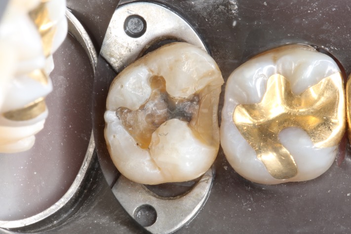 Alan Tamashiro #15 caries removal