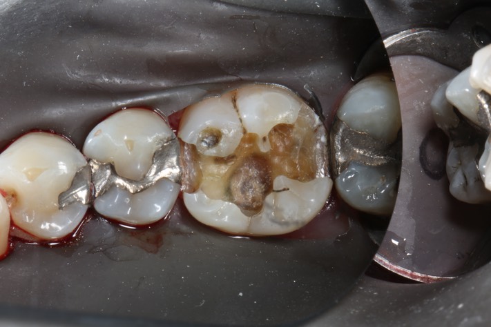 Larry Fujioka #19 amalgam removal