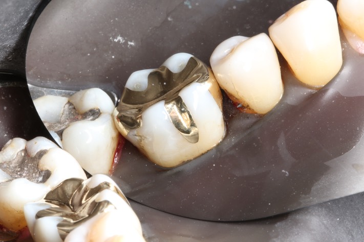 Alan Chinn #19 buccal view