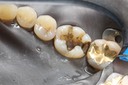 Frank Fukuda #19 caries removal