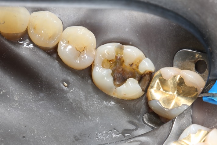 Frank Fukuda #19 caries removal
