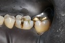 Frank Fukuda #19 caries removal buccal