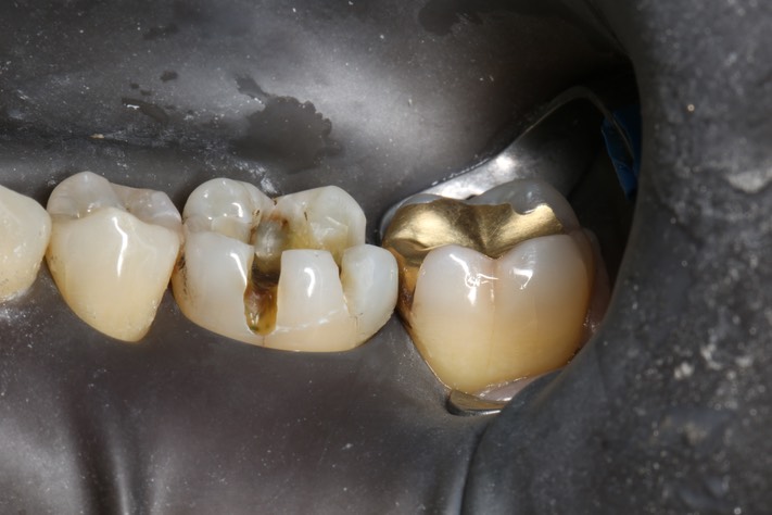 Frank Fukuda #19 caries removal buccal