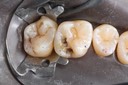 Kyle Chock #14 caries removal