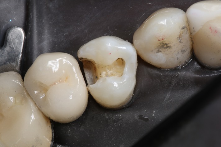 Bryan Sato #12 caries removal