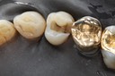 Russ Tabata #5 caries removal