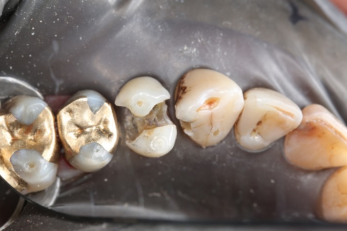 Larry Fujioka #12-12 caries removal