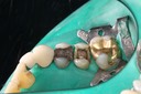 Mendel Sato #4 caries removal