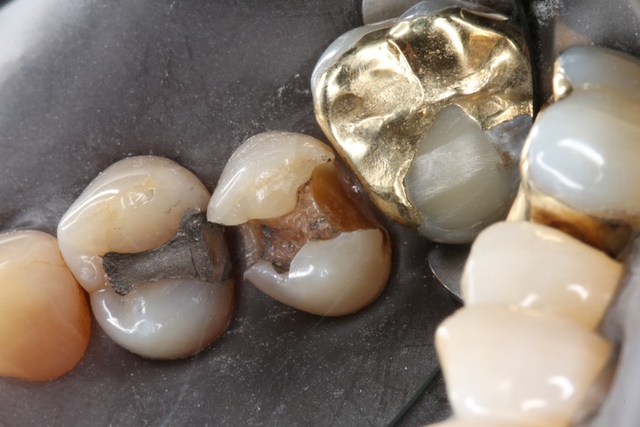Wes Sato #4 caries removal