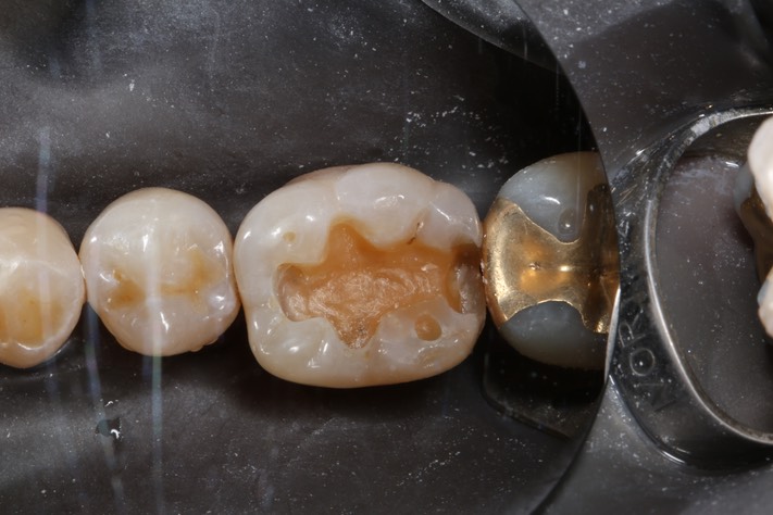 Scott Kanamori #19 caries removal