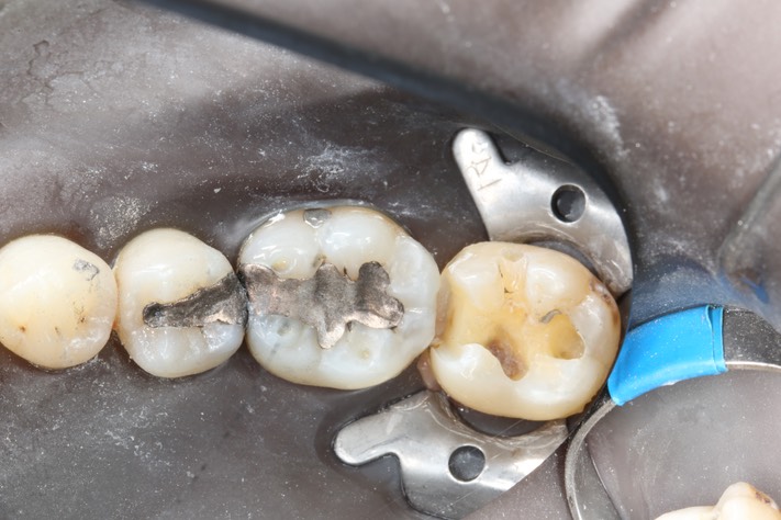Frank Fukuda #18 amalgam removal