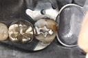 Kyle Chock #18 occlusal reduction