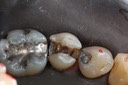 Scott Kanamori #29 caries removal