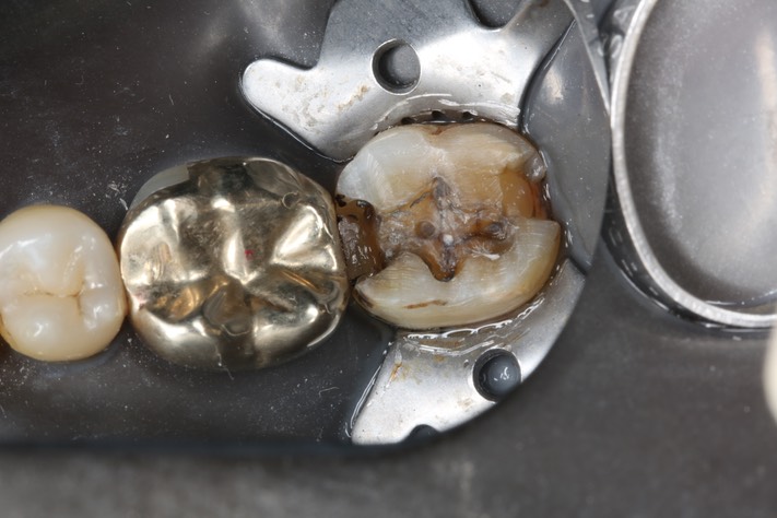 Kyle Chock #18 caries removal