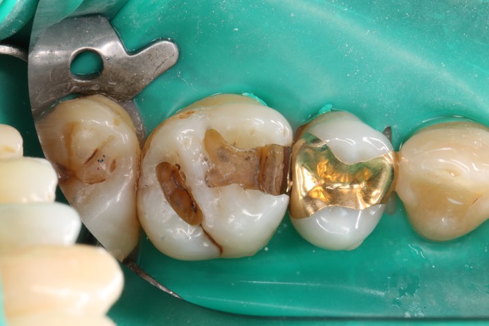 Alan Tamashiro #14 amalgam removal