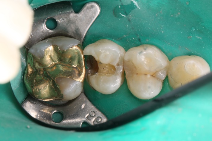 Mendel Sato #13 amalgam removal