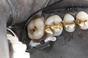 Ted Kanamori #15 amalgam removal