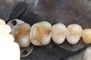 Russ Tabata #14 amalgam removal