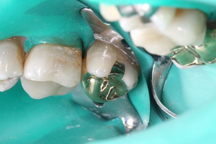 Mark Chun #2 finish buccal view