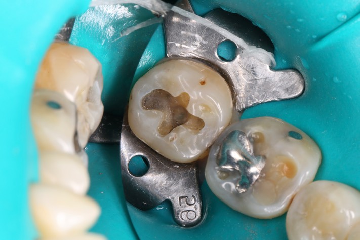 Bryan Sato #31 amalgam removal