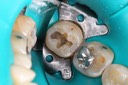 Bryan Sato #31 amalgam removal