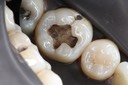 Wes Sato #30 amalgam removal