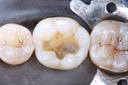 Alan Chinn #19 amalgam removal