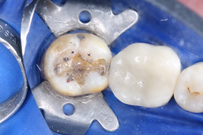 Mark Chun #31 amalgam removal