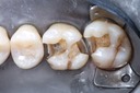 Ted Kanamori #2-3 amalgam removal