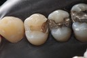 Wayne Chin #5 amalgam removal