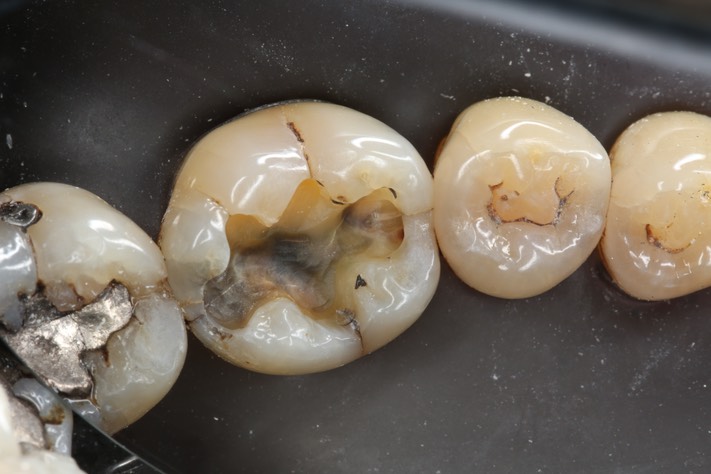 Alan Tamashiro #30 caries removal 2