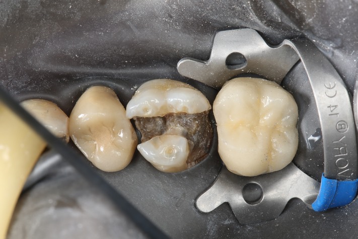 Frank Fukuda #3 caries removal