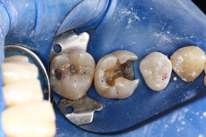 Mark Chun #14 caries removal