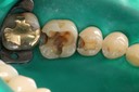 Ted Kanamori #29 - 30 caries removal
