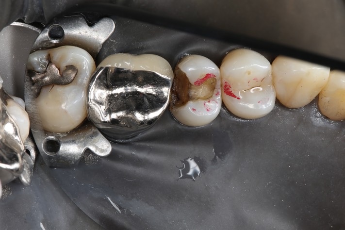 Kyle Chock #13 caries removal