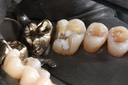 Alan Chinn #14 prep - lingual view