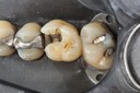 Gary Umeda #3 amalgam removal