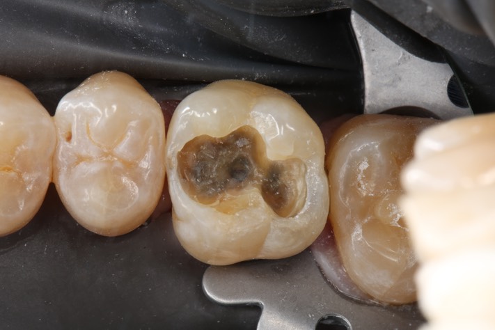 20Matt Dodson #3 caries removal