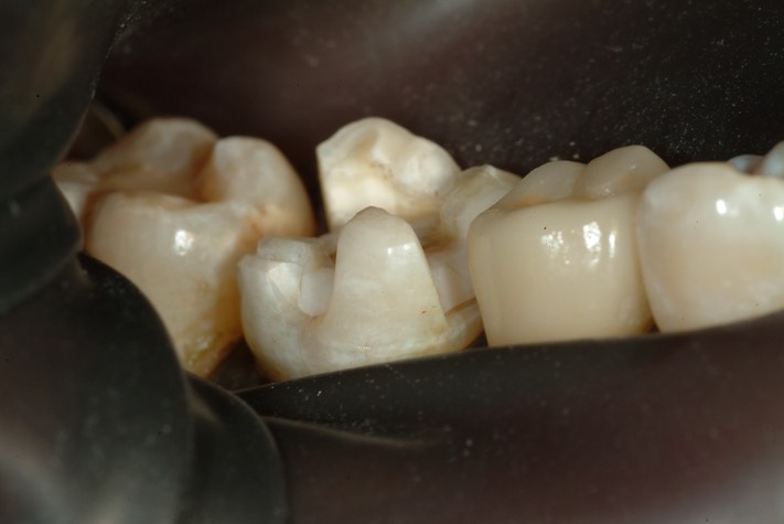 Larry Fujioka #30 prep -buccal view