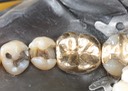 Frank Fukuda #20 amalgam removal