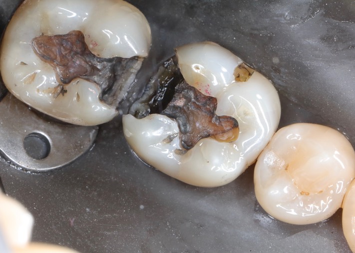 Kyle Chock #30-31 caries removal