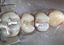 Joe Cha #13 amalgam removal