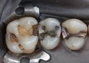 Matt Dodson #14 amalgam removal