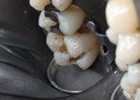 Matt Dodson #14 amalgam removal lkngual view