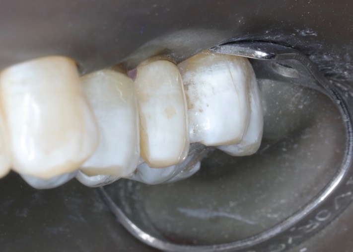 Joe Cha #13 prep buccal view