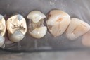 29Larry Fujioka #11-12 caries removal