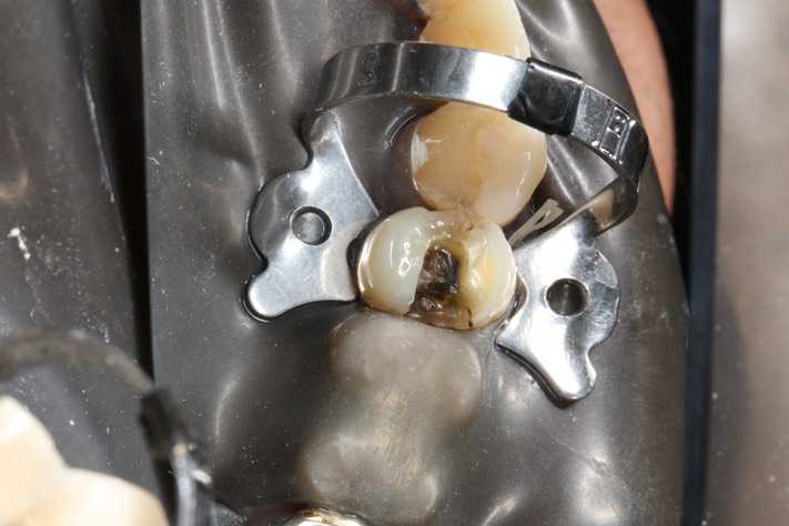 2Wayne Chin #5 amalgam removal