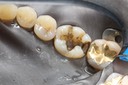 37Frank Fukuda #19 caries removal