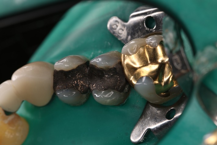 58Mendel Sato #4 pre-op