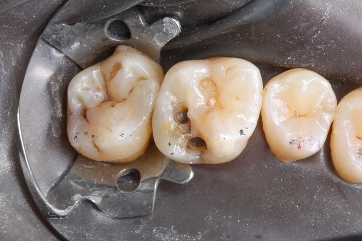 5Kyle Chock #14 caries removal